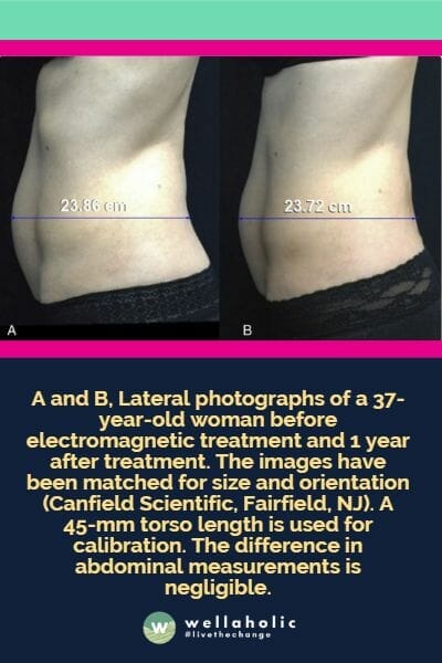 A and B, Lateral photographs of a 37-year-old woman before electromagnetic treatment and 1 year after treatment. The images have been matched for size and orientation (Canfield Scientific, Fairfield, NJ). A 45-mm torso length is used for calibration. The difference in abdominal measurements is negligible.