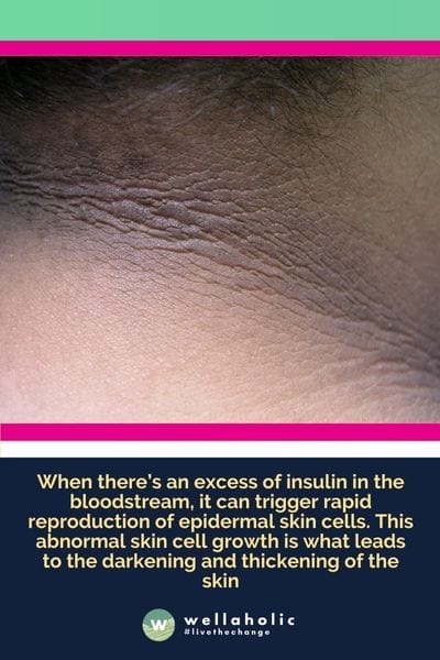 Acanthosis Nigricans and skin darkening