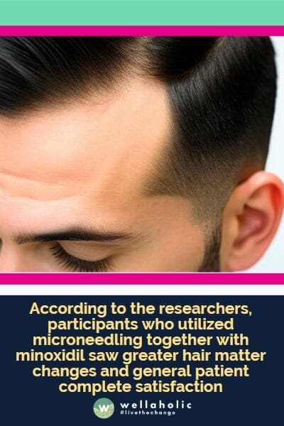 According to the researchers, participants who utilized microneedling together with minoxidil saw greater hair matter changes and general patient complete satisfaction