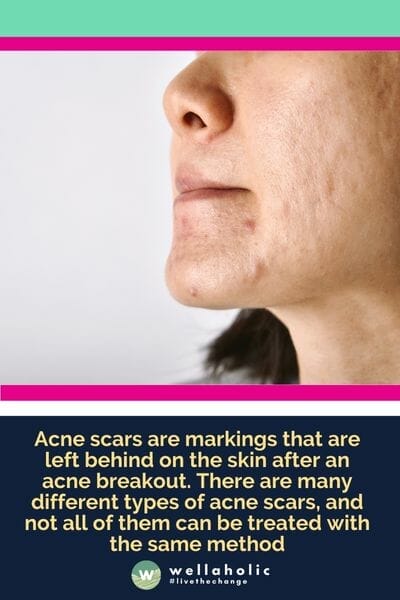 Acne scars are markings that are left behind on the skin after an acne breakout. There are many different types of acne scars, and not all of them can be treated with the same method