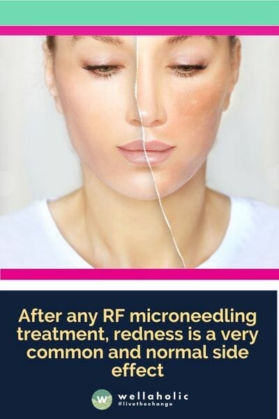 After any RF microneedling treatment, redness is a very common and normal side effect