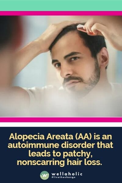 Alopecia Areata (AA) is an autoimmune disorder that leads to patchy, nonscarring hair loss.