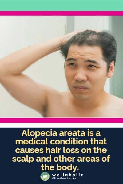 Alopecia areata is a medical condition that causes hair loss on the scalp and other areas of the body.