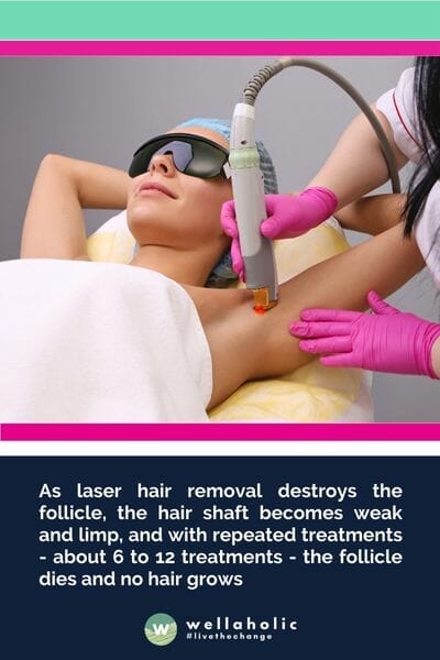 随着激光脱毛摧毁了毛囊，毛发变得虚弱而无力，经过大约6到12次的治疗，毛囊会死亡，不再生长毛发。