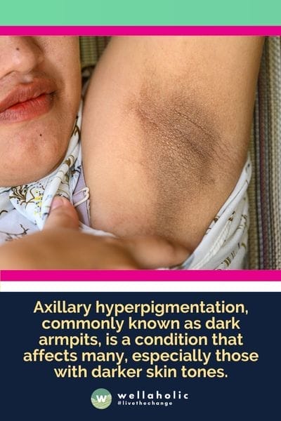 Axillary hyperpigmentation, commonly known as dark armpits, is a condition that affects many, especially those with darker skin tones.