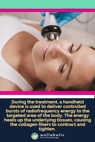 During the treatment, a handheld device is used to deliver controlled bursts of radiofrequency energy to the targeted area of the body. The energy heats up the underlying tissues, causing the collagen fibers to contract and tighten. 