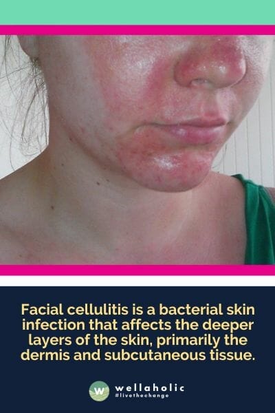 Facial cellulitis is a bacterial skin infection that affects the deeper layers of the skin, primarily the dermis and subcutaneous tissue.