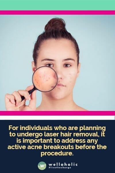 For individuals who are planning to undergo laser hair removal, it is important to address any active acne breakouts before the procedure.