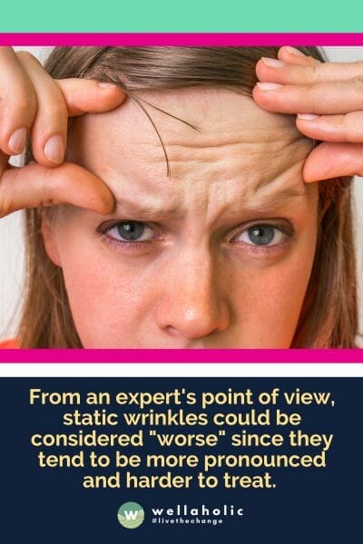 From an expert's point of view, static wrinkles could be considered "worse" since they tend to be more pronounced and harder to treat.