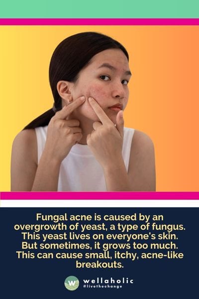 Fungal acne is caused by an overgrowth of yeast, a type of fungus. This yeast lives on everyone's skin. But sometimes, it grows too much. This can cause small, itchy, acne-like breakouts.