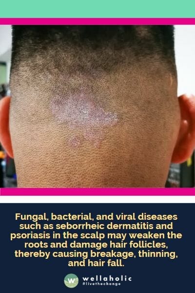 Fungal, bacterial, and viral diseases such as seborrheic dermatitis and psoriasis in the scalp may weaken the roots and damage hair follicles, thereby causing breakage, thinning, and hair fall.