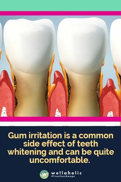 Gum irritation is a common side effect of teeth whitening and can be quite uncomfortable. 