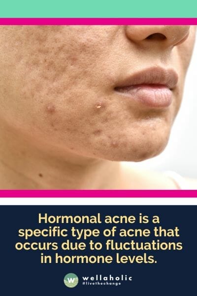 Hormonal acne is a specific type of acne that occurs due to fluctuations in hormone levels.