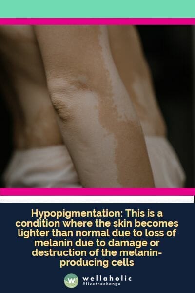 Hypopigmentation: This is a condition where the skin becomes lighter than normal due to loss of melanin due to damage or destruction of the melanin-producing cells