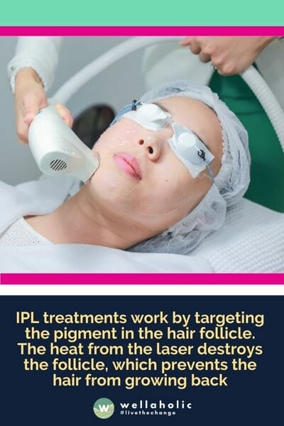 IPL（闪光脉冲光）治疗通过瞄准毛囊中的色素来发挥作用。激光的热量破坏毛囊，从而阻止毛发再生。