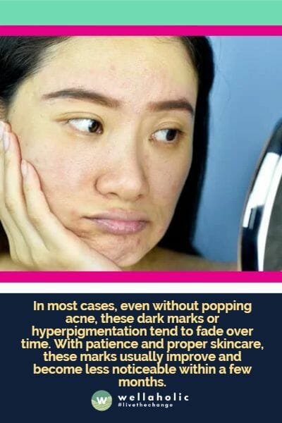 In most cases, even without popping acne, these dark marks or hyperpigmentation tend to fade over time. With patience and proper skincare, these marks usually improve and become less noticeable within a few months.