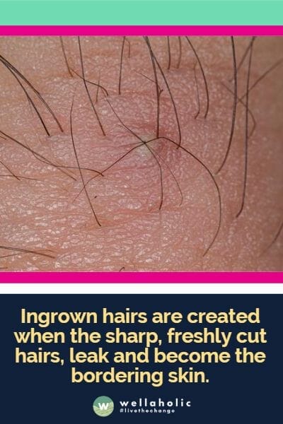 Ingrown hairs are created when the sharp, freshly cut hairs, leak and become the bordering skin.