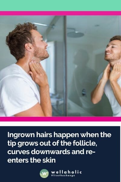 Ingrown hairs happen when the tip grows out of the follicle, curves downwards and re-enters the skin