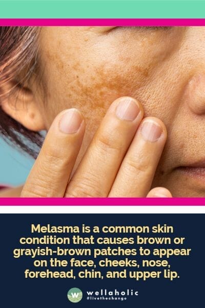 Melasma is a common skin condition that causes brown or grayish-brown patches to appear on the face, cheeks, nose, forehead, chin, and upper lip.
