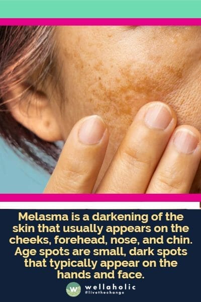 Melasma is a darkening of the skin that usually appears on the cheeks, forehead, nose, and chin. Age spots are small, dark spots that typically appear on the hands and face.