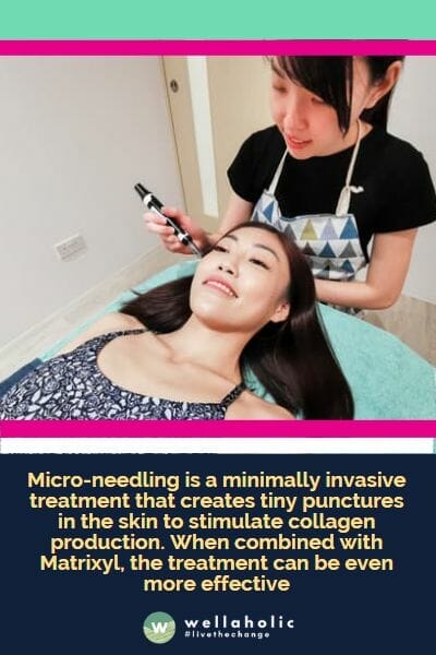 Micro-needling is a minimally invasive treatment that creates tiny punctures in the skin to stimulate collagen production. When combined with Matrixyl, the treatment can be even more effective