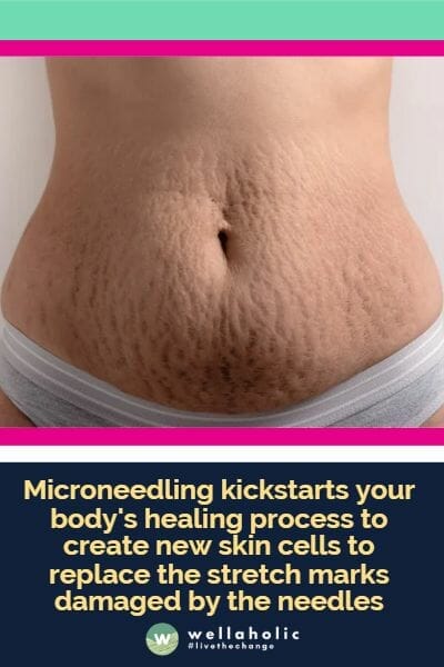 Microneedling kickstarts your body's healing process to create new skin cells to replace the stretch marks damaged by the needles