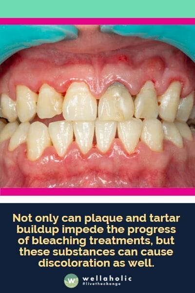 Not only can plaque and tartar buildup impede the progress of bleaching treatments, but these substances can cause discoloration as well.