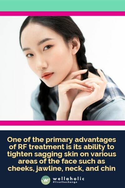 One of the primary advantages of RF treatment is its ability to tighten sagging skin on various areas of the face such as cheeks, jawline, neck, and chin