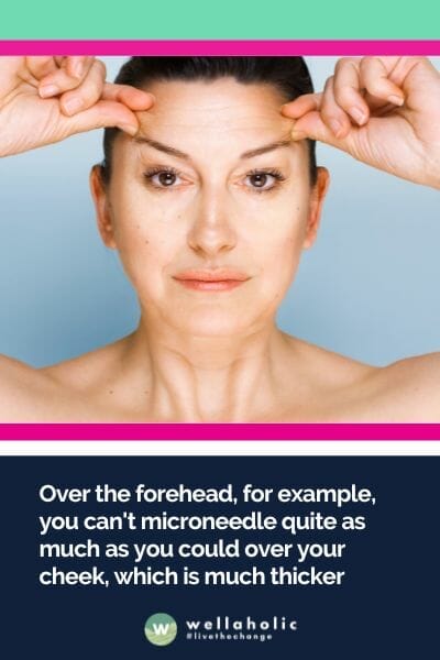 "Over the forehead, for example, you can't microneedle quite as much as you could over your cheek, which is much thicker