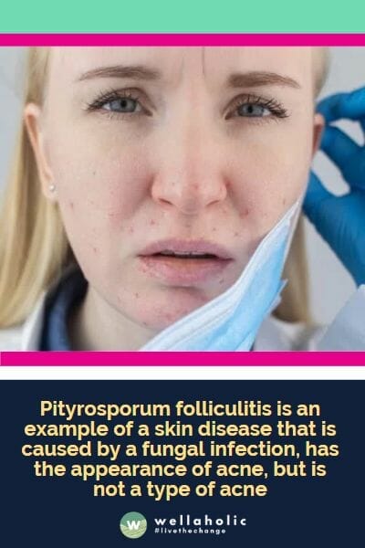 Pityrosporum folliculitis is an example of a skin disease that is caused by a fungal infection, has the appearance of acne, but is not a type of acne