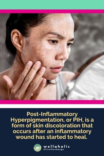 Post-Inflammatory Hyperpigmentation, or PIH, is a form of skin discoloration that occurs after an inflammatory wound has started to heal.