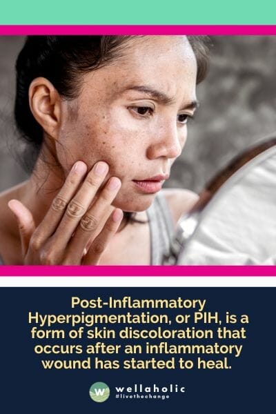 Post-Inflammatory Hyperpigmentation, or PIH, is a form of skin discoloration that occurs after an inflammatory wound has started to heal. 