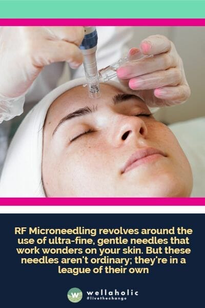 RF Microneedling revolves around the use of ultra-fine, gentle needles that work wonders on your skin. But these needles aren't ordinary; they're in a league of their own