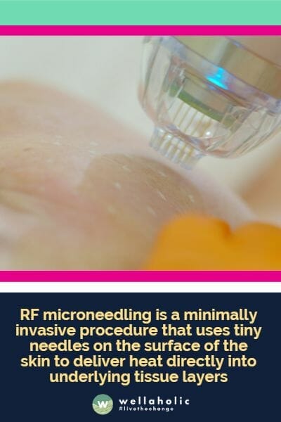 RF microneedling is a minimally invasive procedure that uses tiny needles on the surface of the skin to deliver heat directly into underlying tissue layers