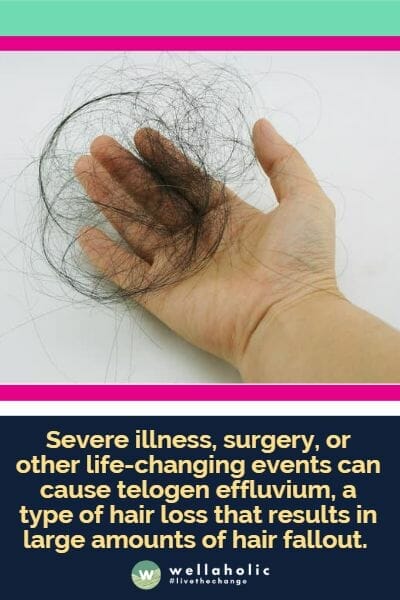Severe illness, surgery, or other life-changing events can cause telogen effluvium, a type of hair loss that results in large amounts of hair fallout. 