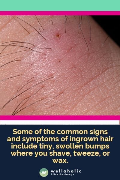 Some of the common signs and symptoms of ingrown hair include tiny, swollen bumps where you shave, tweeze, or wax.