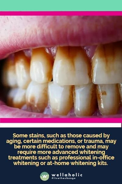 Some stains, such as those caused by aging, certain medications, or trauma, may be more difficult to remove and may require more advanced whitening treatments such as professional in-office whitening or at-home whitening kits. 