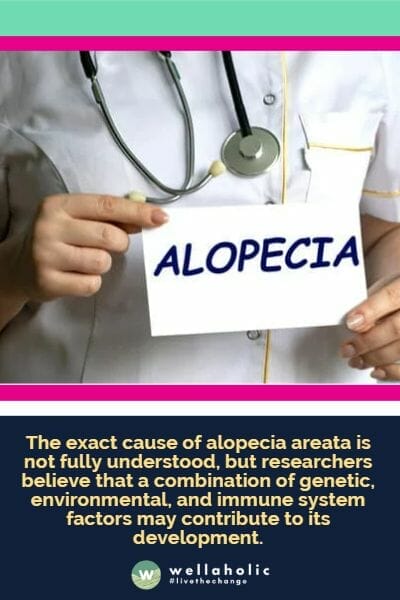 The exact cause of alopecia areata is not fully understood, but researchers believe that a combination of genetic, environmental, and immune system factors may contribute to its development.