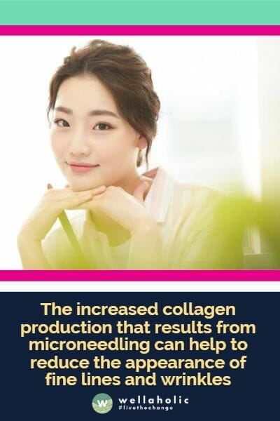 The increased collagen production that results from microneedling can help to reduce the appearance of fine lines and wrinkles