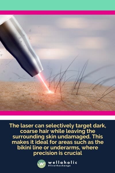 The laser can selectively target dark, coarse hair while leaving the surrounding skin undamaged. This makes it ideal for areas such as the bikini line or underarms, where precision is crucial