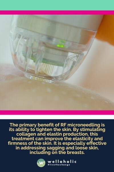 The primary benefit of RF microneedling is its ability to tighten the skin. By stimulating collagen and elastin production, this treatment can improve the elasticity and firmness of the skin. It is especially effective in addressing sagging and loose skin, including on the breasts.