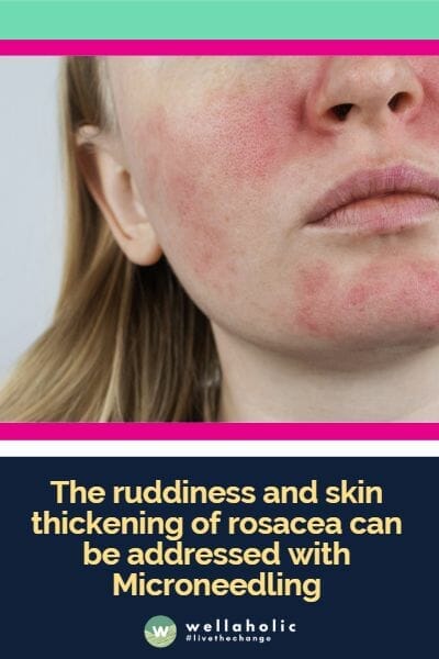 微针美容可以缓解酒渣鼻（Rosacea）引起的红润和皮肤增厚问题。