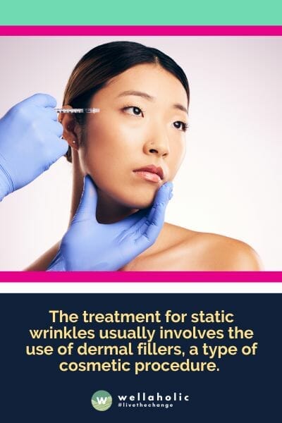 The treatment for static wrinkles usually involves the use of dermal fillers, a type of cosmetic procedure.