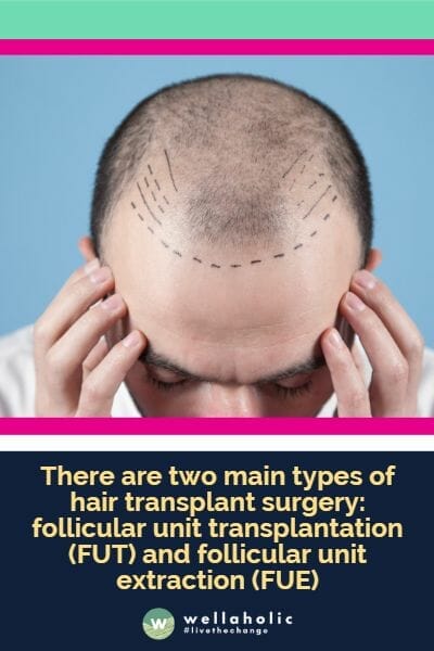 There are two main types of hair transplant surgery: follicular unit transplantation (FUT) and follicular unit extraction (FUE)