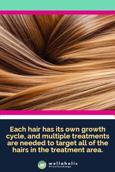 达到激光脱毛的最佳效果所需的治疗次数因人而异。这是因为每根毛发都有自己的生长周期，需要多次治疗才能针对治疗区域内的所有毛发。