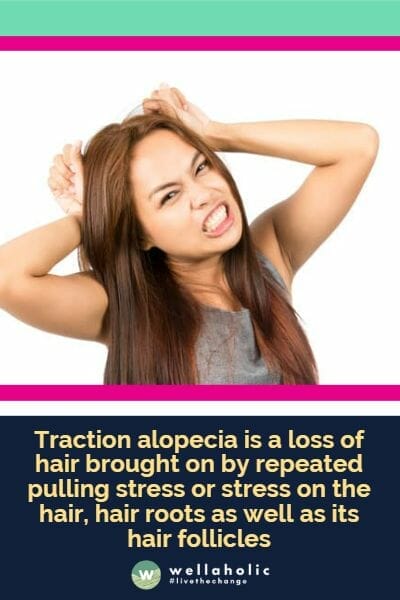 Traction alopecia is a loss of hair brought on by repeated pulling stress or stress on the hair, hair roots as well as its hair follicles