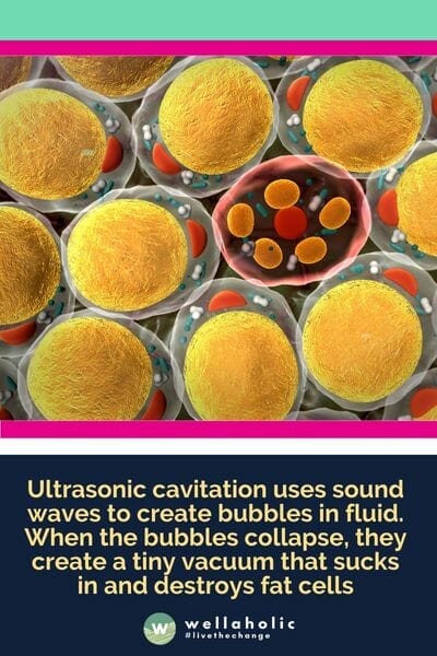 Ultrasonic cavitation uses sound waves to create bubbles in fluid. When the bubbles collapse, they create a tiny vacuum that sucks in and destroys fat cells
