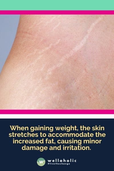 When gaining weight, the skin stretches to accommodate the increased fat, causing minor damage and irritation. 