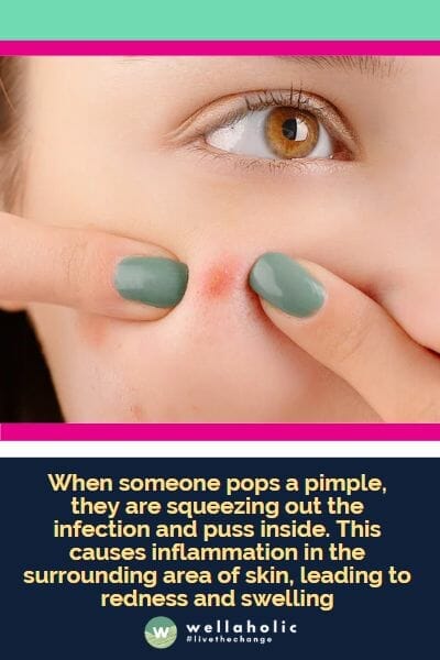 当有人挤压痘痘时，他们将把感染和脓液挤出。这会导致周围皮肤发生炎症，造成红肿。