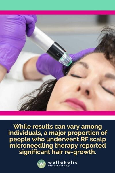 While results can vary among individuals, a major proportion of people who underwent RF scalp microneedling therapy reported significant hair re-growth.